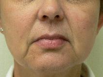 Hyaluronic Acid Before